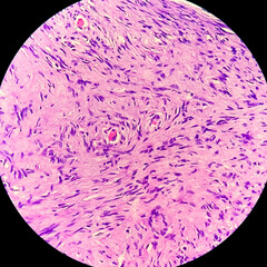 Spinal schwannoma, spinal tumor histology showing schwannoma