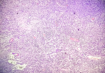 Spinal schwannoma, spinal tumor histology showing schwannoma