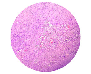 Spinal schwannoma, spinal tumor histology showing schwannoma