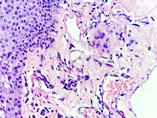 Photomicrograph of a pterygium of conjunctiva, with prominent degenerative changes of solar elastosis, related to exposure to ultraviolet (UV) light.