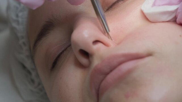 Beautician wearing gloves removes pimples from patient's nose using metal tool in professional beauty clinic. Face cleaning, skin care.