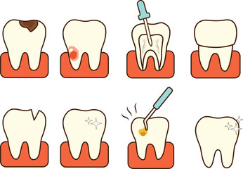 Tooth Decay and Dental Treatment Process &ndash; Cavity Filling and Root Canal Illustration