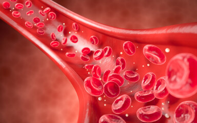 3d illustration of narrowed blood vessel due to atherosclerosis, Symptoms of high cholesterol in the blood