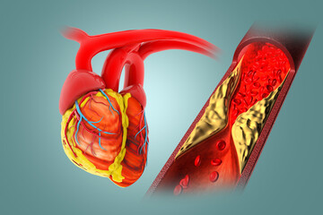 Cholesterol blocked artery with heart. 3d illustration