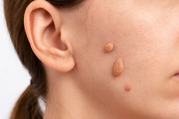 Obraz premium Close up of woman face with multiple papillomas on skin isolated on white background. Concept of skin disease, dermatology, viral infection, medical problem, diagnosis and treatment