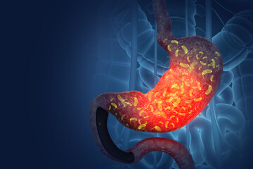 Viral gastroenteritis (stomach flu). human digestive system infected by virus or bacteria. 3d illustration