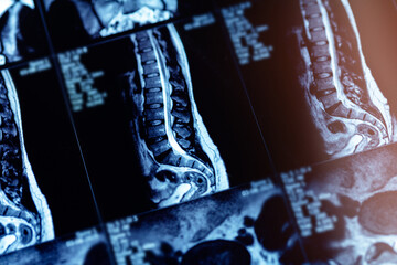 Mri scan of spinal column showing disc protrusion in adult patient