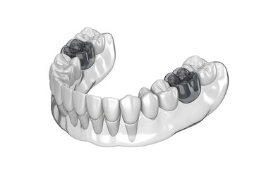 Dental problems on teeth