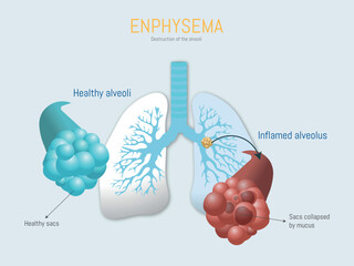 Emphysema destroying alveoli, showing healthy and inflamed lung sacs