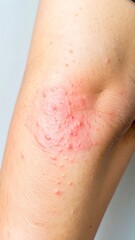 Fototapeta premium Skin rash on human arm