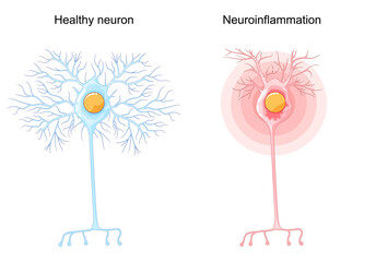Neuroinflammation. Healthy neuron and unhealthy nerve cell
