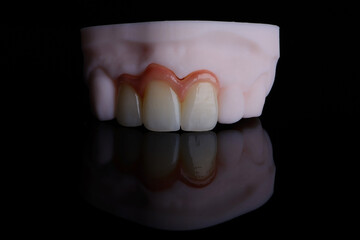 High-quality three dental crowns made of zirconium for fixation to the frontal teeth of upper jaw.