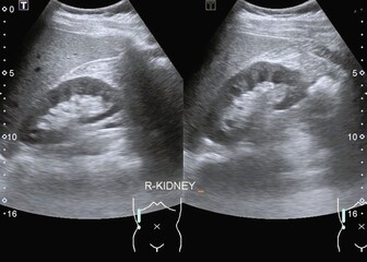 ultrasonography normal kidney 
normal renal anatomy 