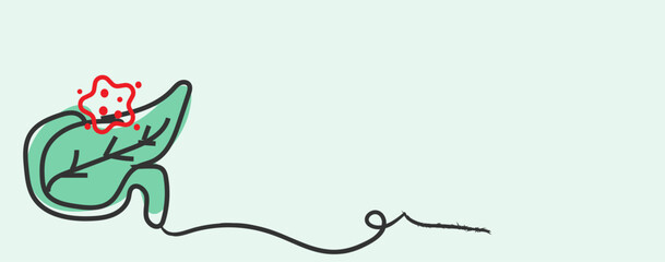  Pancreatic cancer forms in the tissues of the pancreas, an organ crucial for digestion and blood sugar regulation