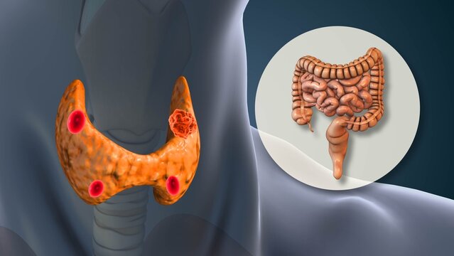 Hyperparathyroidism Stimulating Small Intestine Calcium Absorption