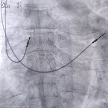 X ray image showed dual chamber permanent pacemaker (PPM) leads in left chest at Cath Laboratory.