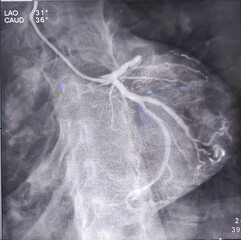 Coronary angiogram of left coronary artery during cardiac catheterization with contrast dye. Abnormal findings. Colour adjust.