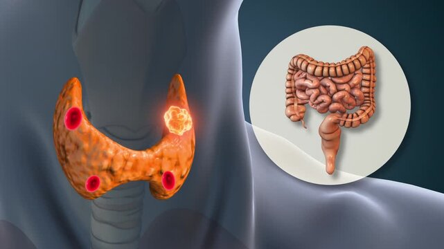 Hyperparathyroidism Stimulating Small Intestine Calcium Absorption