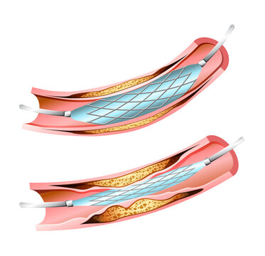 Heart Stent Procedure - Stock Illustration