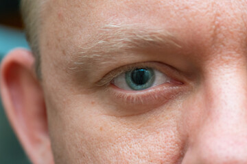 Inflamed human eye caused by bacterial infection and laser eye surgery. Close-up view