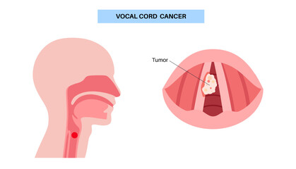 Vocal cord cancer medical poster