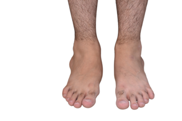 Flat feet. Front view of male feet showing flat arches and toes, barefoot human anatomy, isolated on transparent background.