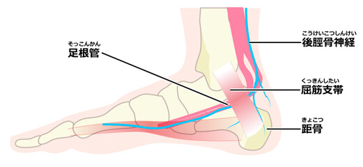  足根管症候群