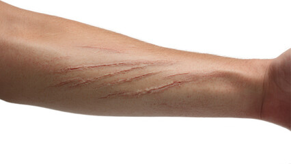 Injury recovery process arm with scars medical photography clinical environment close-up view healing concept