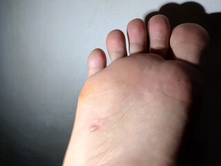 Dyshidrosis of the feet is a type of eczema characterized by the appearance of small, itchy, fluid-filled blisters on the soles of the feet and between the toes.