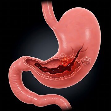 a stomach with a severe gastric hemorrhage (bleeding). The stomach wall itself shows signs of irritation and inflammation around the bleeding site.