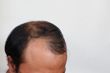 Fototapeta premium Asian Man with hair loss problems closeup, isolated on white background. Alopecia balding hairs on man scalp. Person hand pointing his bald head. Scratching his head. Baldness. Depression, stress.