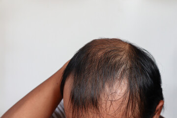 Fototapeta premium Asian Man with hair loss problems closeup, isolated on white background. Alopecia balding hairs on man scalp. Person hand pointing his bald head. Scratching his head. Baldness. Depression, stress.