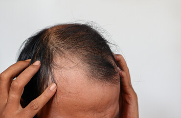 Fototapeta premium Asian Man with hair loss problems closeup, isolated on white background. Alopecia balding hairs on man scalp. Person hand pointing his bald head. Scratching his head. Baldness. Depression, stress.