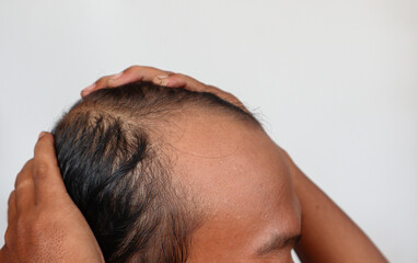Fototapeta premium Asian Man with hair loss problems closeup, isolated on white background. Alopecia balding hairs on man scalp. Person hand pointing his bald head. Scratching his head. Baldness. Depression, stress.