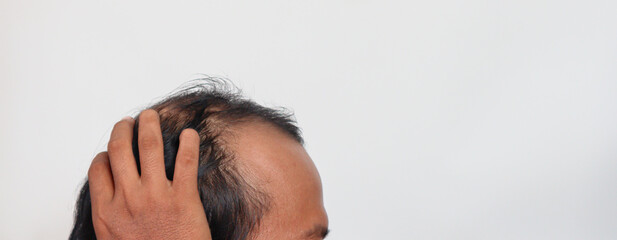 Fototapeta premium Asian Man with hair loss problems closeup, isolated on white background. Alopecia balding hairs on man scalp. Person hand pointing his bald head. Scratching his head. Baldness. Depression, stress.