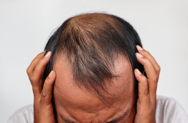 Fototapeta premium Asian Man with hair loss problems closeup, isolated on white background. Alopecia balding hairs on man scalp. Person hand pointing his bald head. Scratching his head. Baldness. Depression, stress.