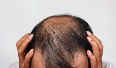 Fototapeta premium Asian Man with hair loss problems closeup, isolated on white background. Alopecia balding hairs on man scalp. Person hand pointing his bald head. Scratching his head. Baldness. Depression, stress.