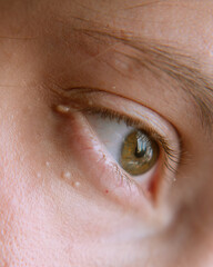 Obraz premium Macro Shot of an Eye with Milia. A detailed macro image of a person's eye, with a focus on the delicate texture of the skin.