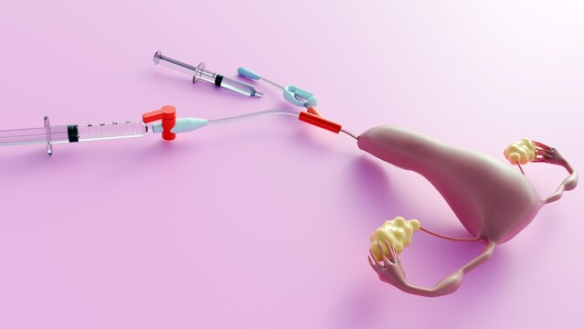 3D rendering the female reproductive system and IUI Delivery System,  illustrating the procedure of Intrauterine Insemination (IUI).
