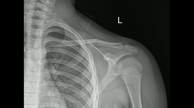 Real X-ray of left shoulder showing Clavicle fracture 