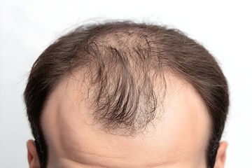 Fototapeta premium Close-up of a man’s forehead showing advanced hair loss and thinning hair on the top of the head. Concept of baldness, alopecia, receding hairline, aging, and hair care treatment solutions.