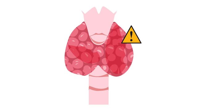 Thyroid disease illustration animation. Thyroid goiter. World thyroid day