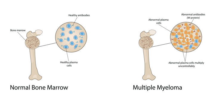 Multiple myeloma vector illustration