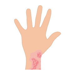 Fototapeta premium Dermantitis Illustration Element. Illustration of a hand affected by allergies. Flat design illustration of a sick hand. Illustration of a hand with red bumps due to allergie