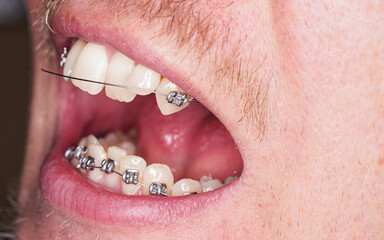 Man with dental braces, upper wire is damaged and loose, closeup detail to open mouth