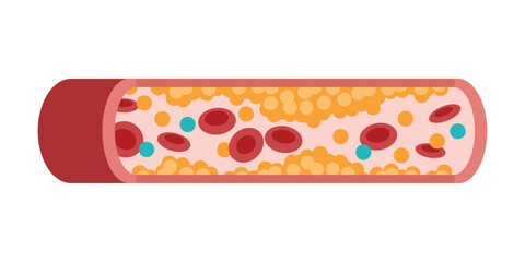 Type of cholesterol in human blood vessels. Low-Density Lipoprotein LDL. High-Density Lipoprotein HDL. Normal artery, blocked vascular, fatty streak, plaque, Moderate. Medical Vector illustration.