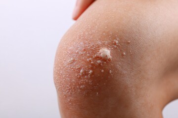 Fototapeta premium Close-up of a person's knee with rough, flaky skin and a whitish, bumpy area