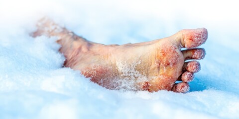 Human foot suffering frostbite injury in deep snow