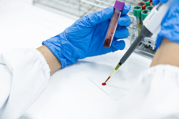 Selective focus doctor or lab technician hand wear blue gloves drip human red blood on slide for malaria test (thick film),blood group test,complete blood count(CBC)with microscope in laboratory. © arcyto