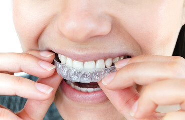 Mujer colocándose férula dental con gel blanqueador en el maxilar superior para blanqueamiento dental.   © Will Labrador